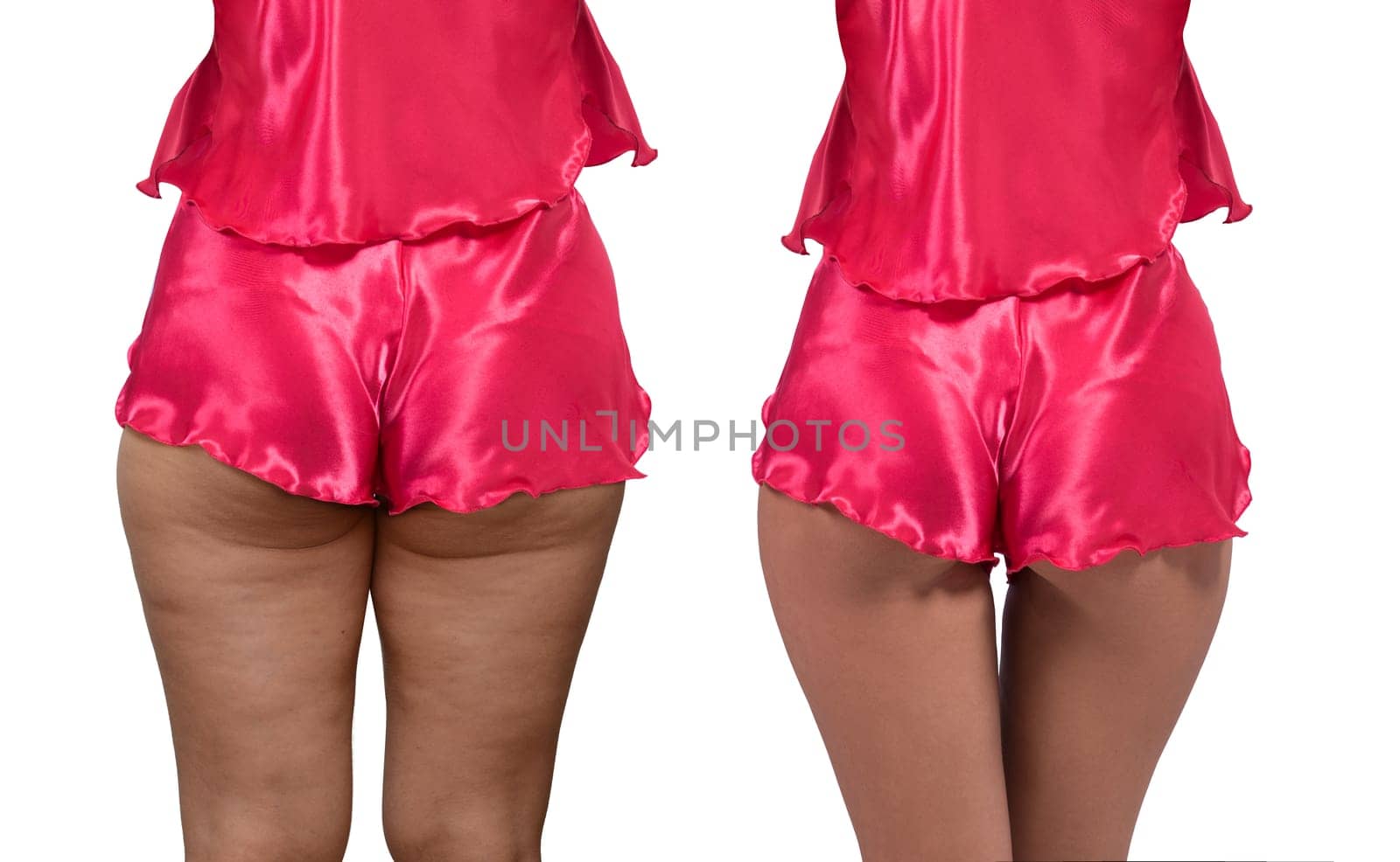 Woman's thighs and buttocks with cellulite. Before and after treatment. Concept of excess weight, diet, sports and needing Improving the skin on legs