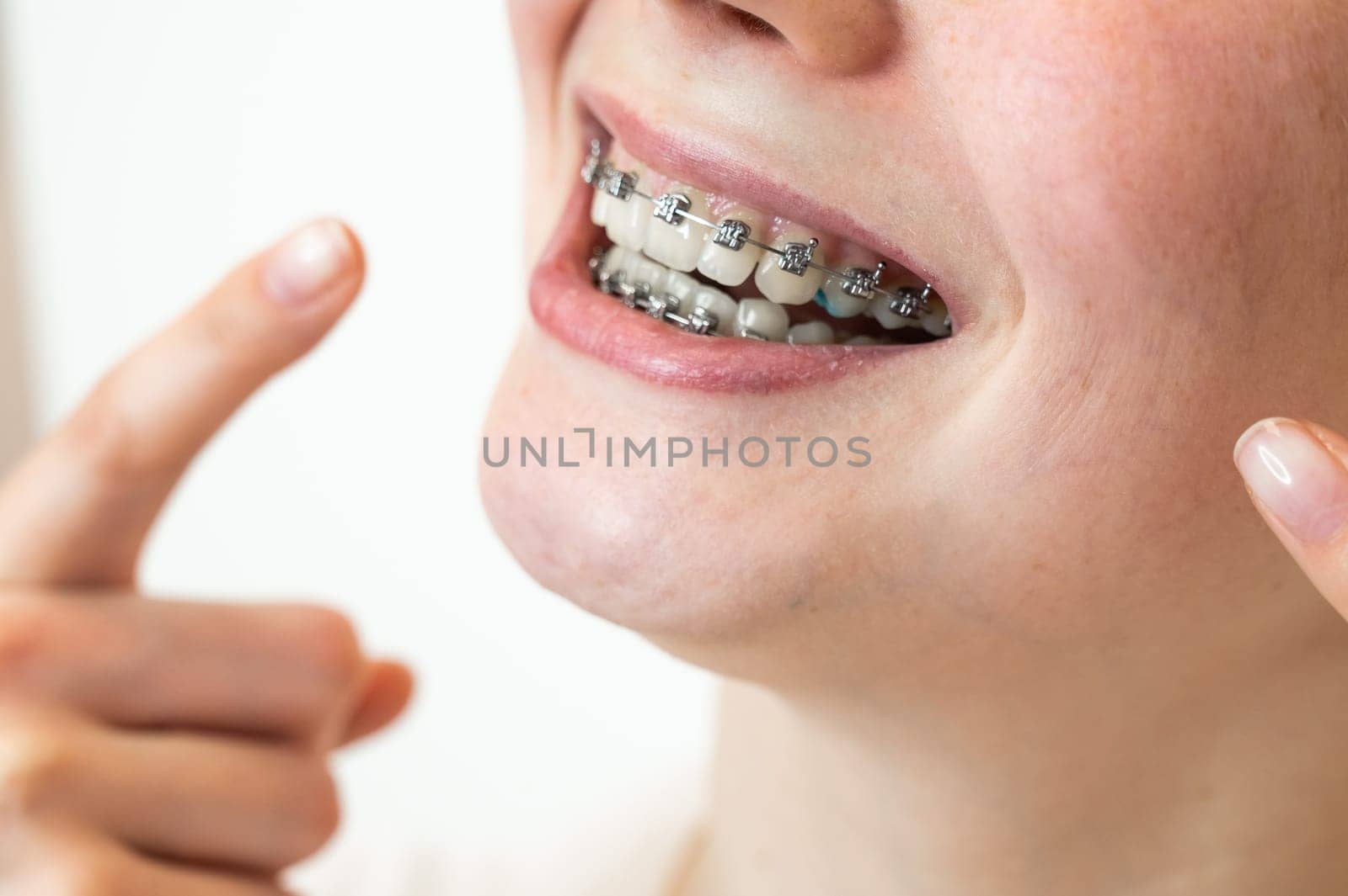 Close-up portrait of a young woman pointing at a smile with braces on her teeth. by mrwed54