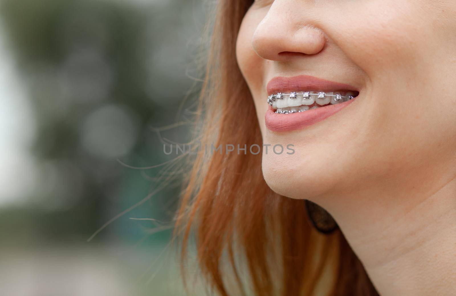 The smile of a young and beautiful girl with braces on her white teeth by AnatoliiFoto