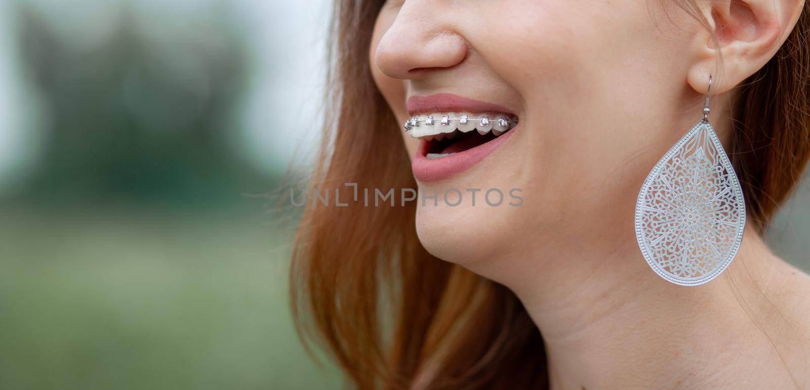 The smile of a young and beautiful girl with braces on her white teeth by AnatoliiFoto