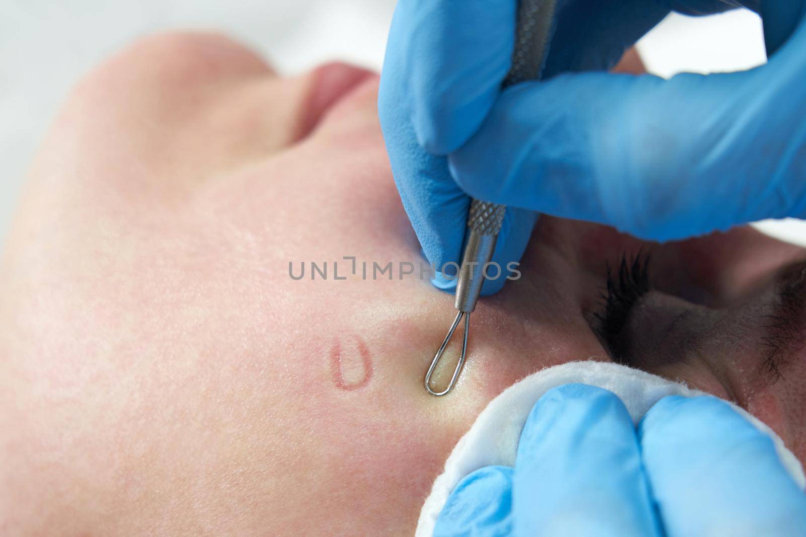 woman uses acne removal stick to remove whitehead pimples on face by squeezing on pimples bump, oily greasy face, Skin problem