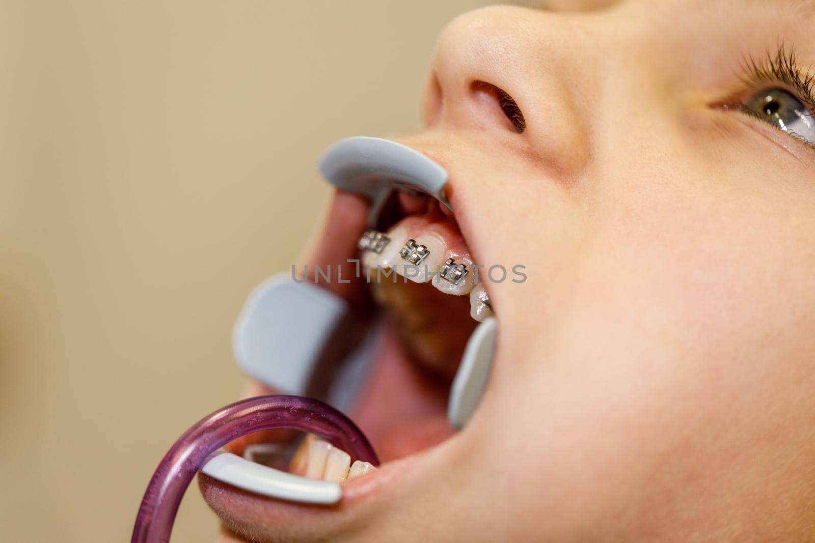 Teenage girl is at the dentist. She sits in the dentist's chair and the dentist sets braces on her teeth.