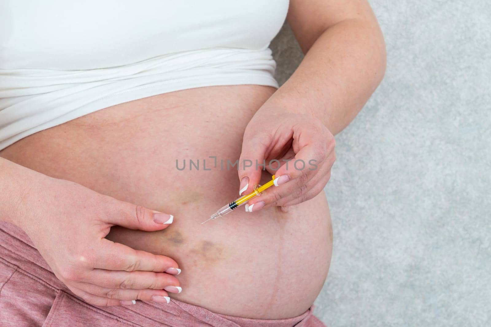 Pregnant woman making injection in stomach with bruises by Mariakray