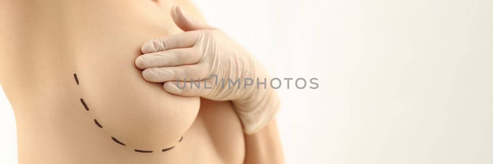 Beautiful woman covering breasts with black surgical lines. Plastic surgery and breast augmentation and lift