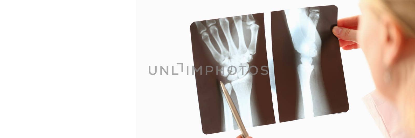 Doctor looks at x-ray of hands closeup by kuprevich