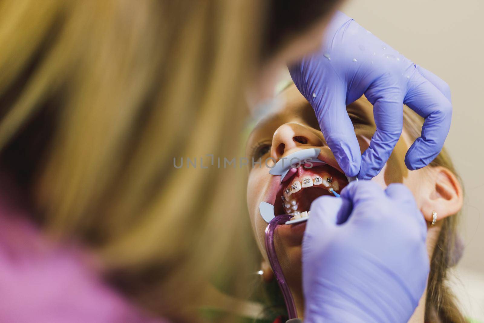 Teenage girl is at the dentist. She sits in the dentist's chair and the dentist sets braces on her teeth.