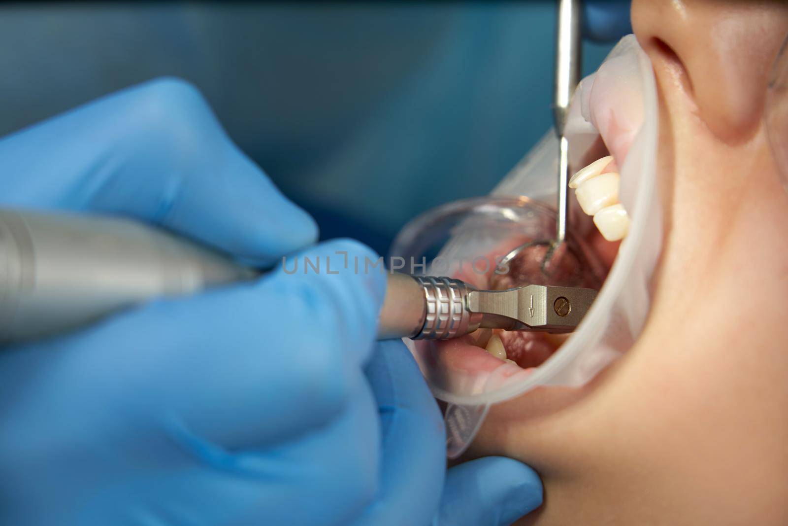 Dentist doing a dental treatment on a patient in medical clinic