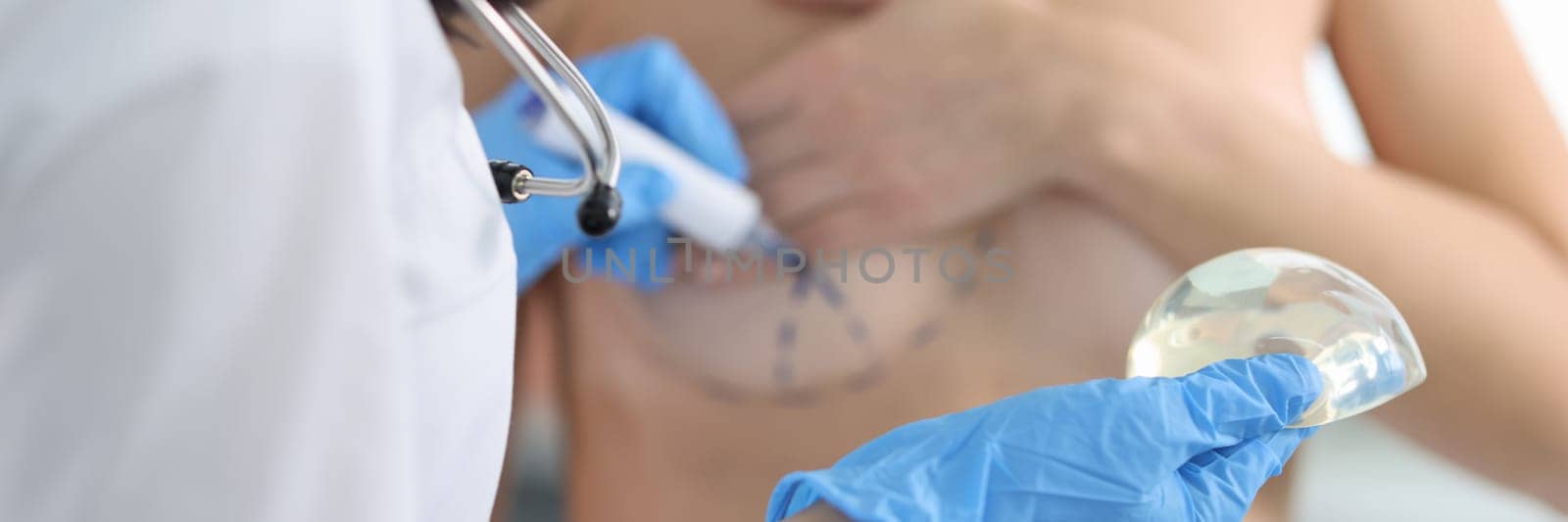 Doctor draws marks on female breast cosmetic surgery operation by kuprevich