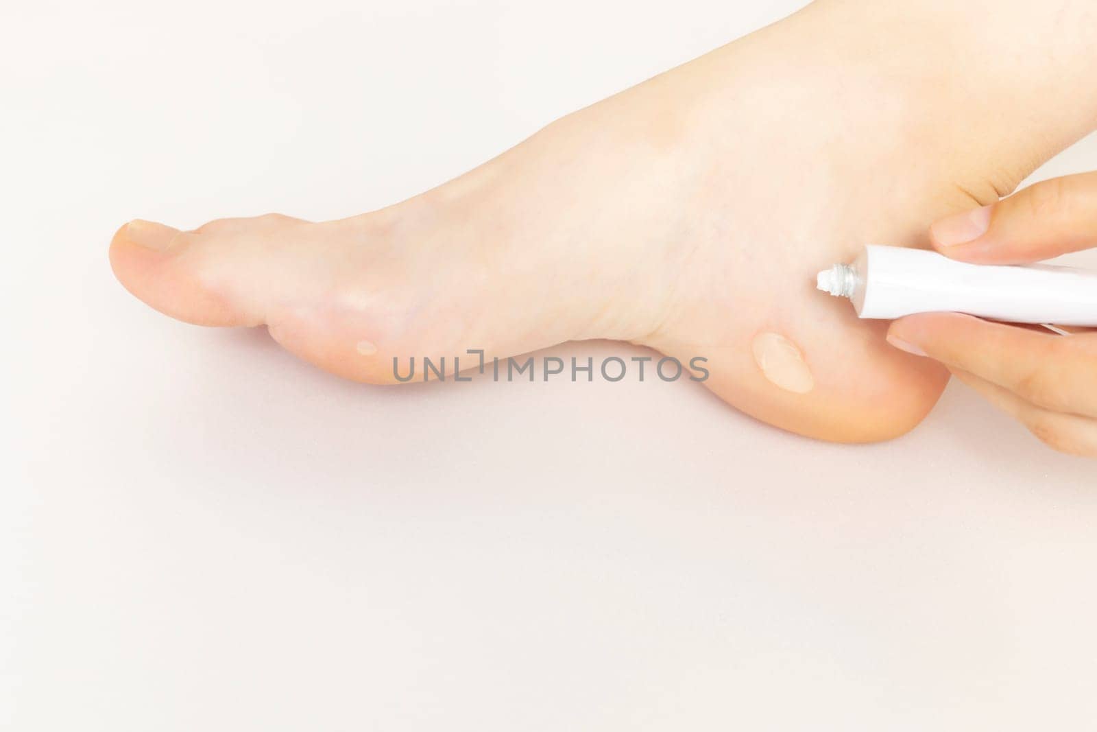 Foot with Healing Cream, Ointment Near Calluses, Skin Corns on Heel and Phalange of Toe. Water Blister Disease On Feet. Person Shows Painful Callosity Before Treatment. Closeup Horizontal. Copy Space.