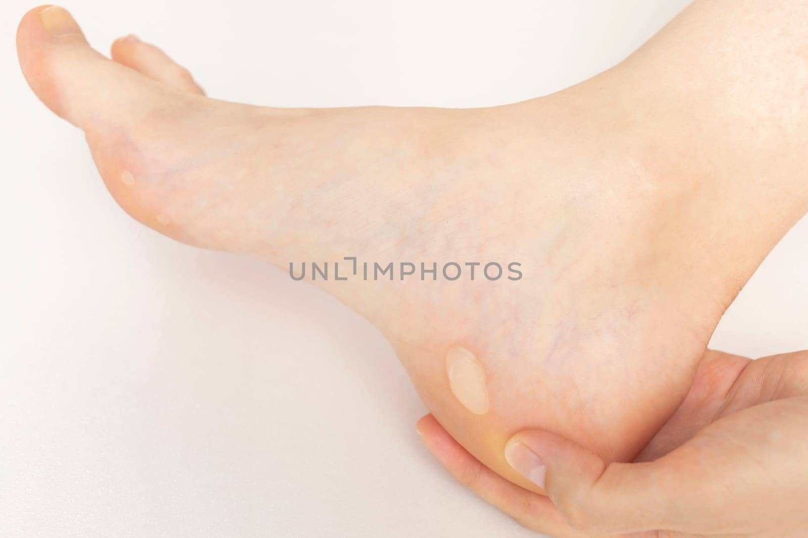 Person Shows Foot with Calluses, Skin Corns on Heel and Phalange of Toe. Water Blister Disease On Feet. Painful Callosity Before Treatment. Closeup Horizontal Plane. Copy Space