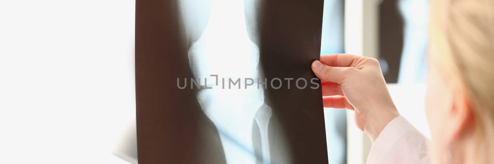 Doctor looks at x-ray film of knee joint before treatment by kuprevich