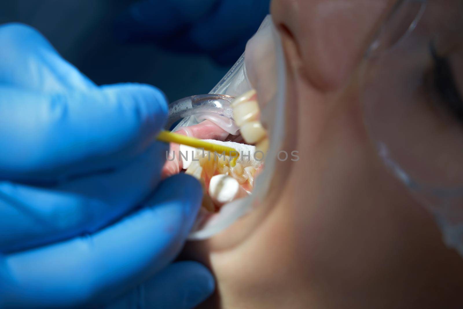 Dentist doing a dental treatment on a patient in medical clinic