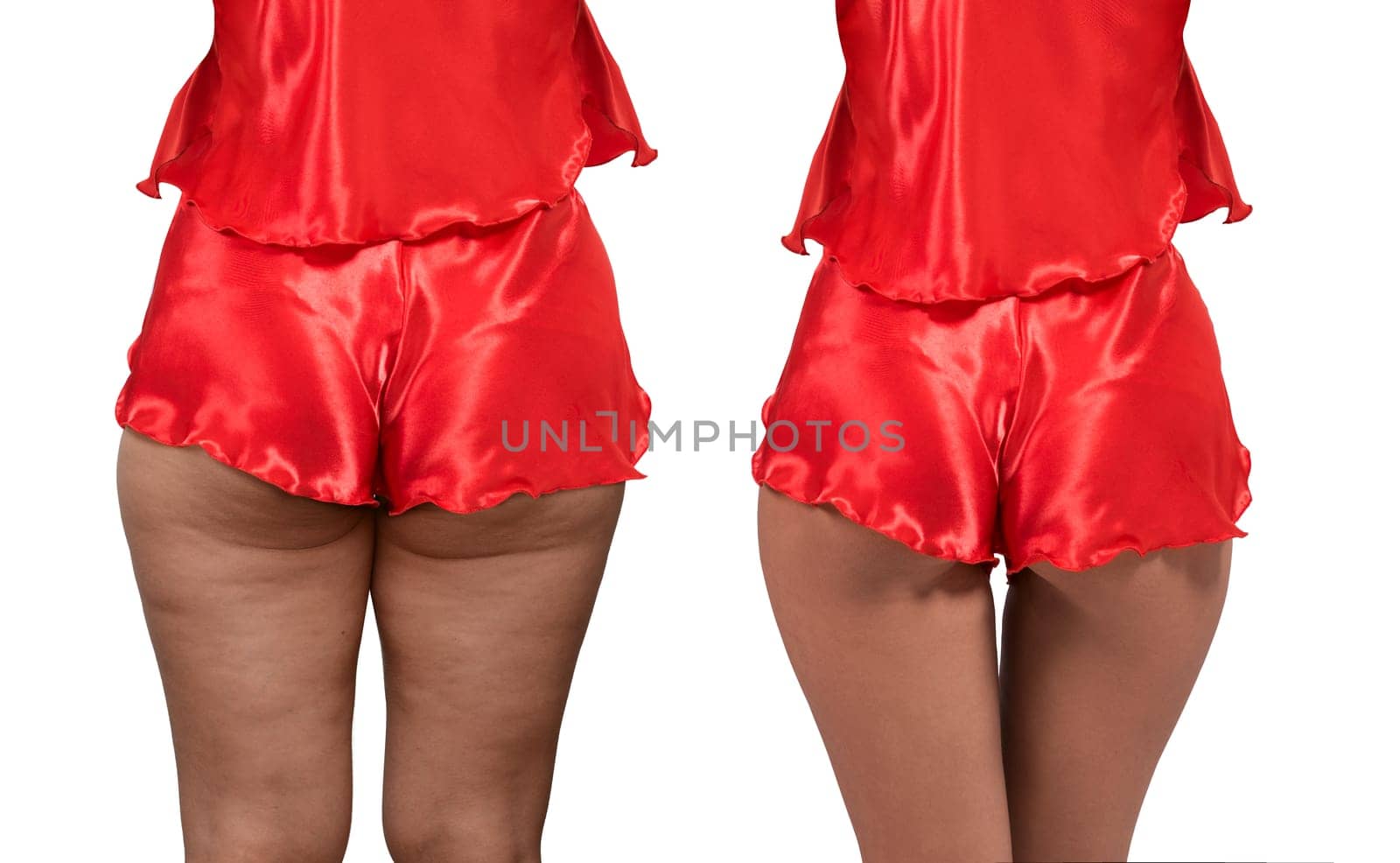 Woman's thighs and buttocks with cellulite. Before and after treatment. Concept of excess weight, diet, sports and needing Improving the skin on legs