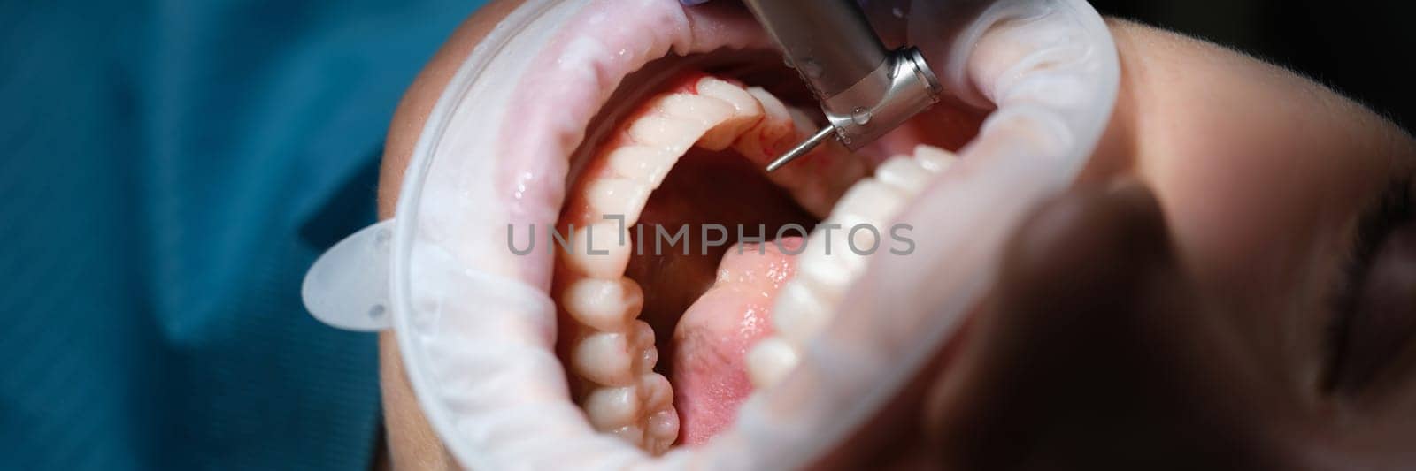 Dentist treating patient teeth with drill in dental clinic closeup. Diagnosis and treatment of caries modern methods concept