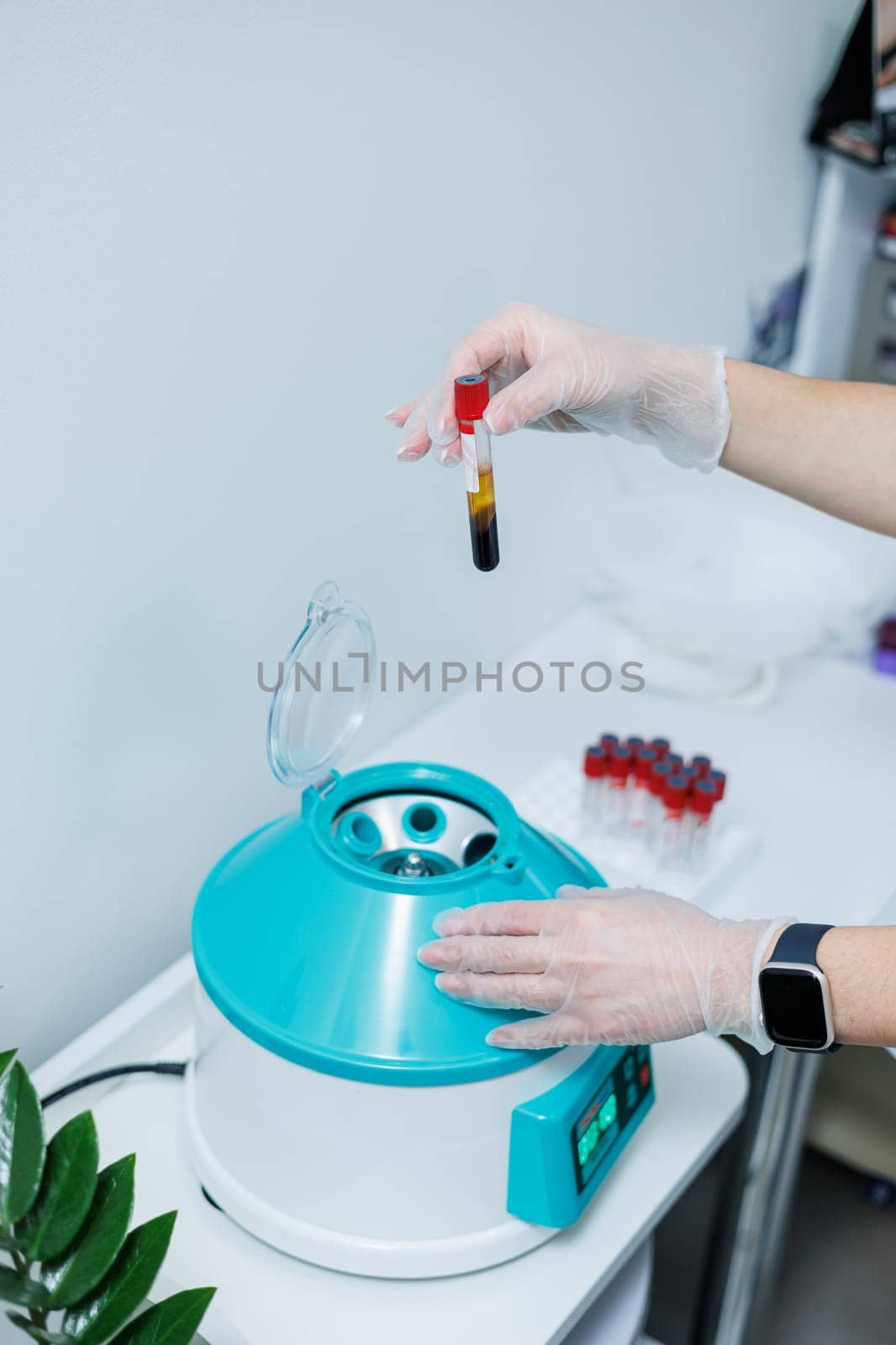 The blood in the test tube is placed in a centrifuge for plasma therapy. Modern medical equipment.