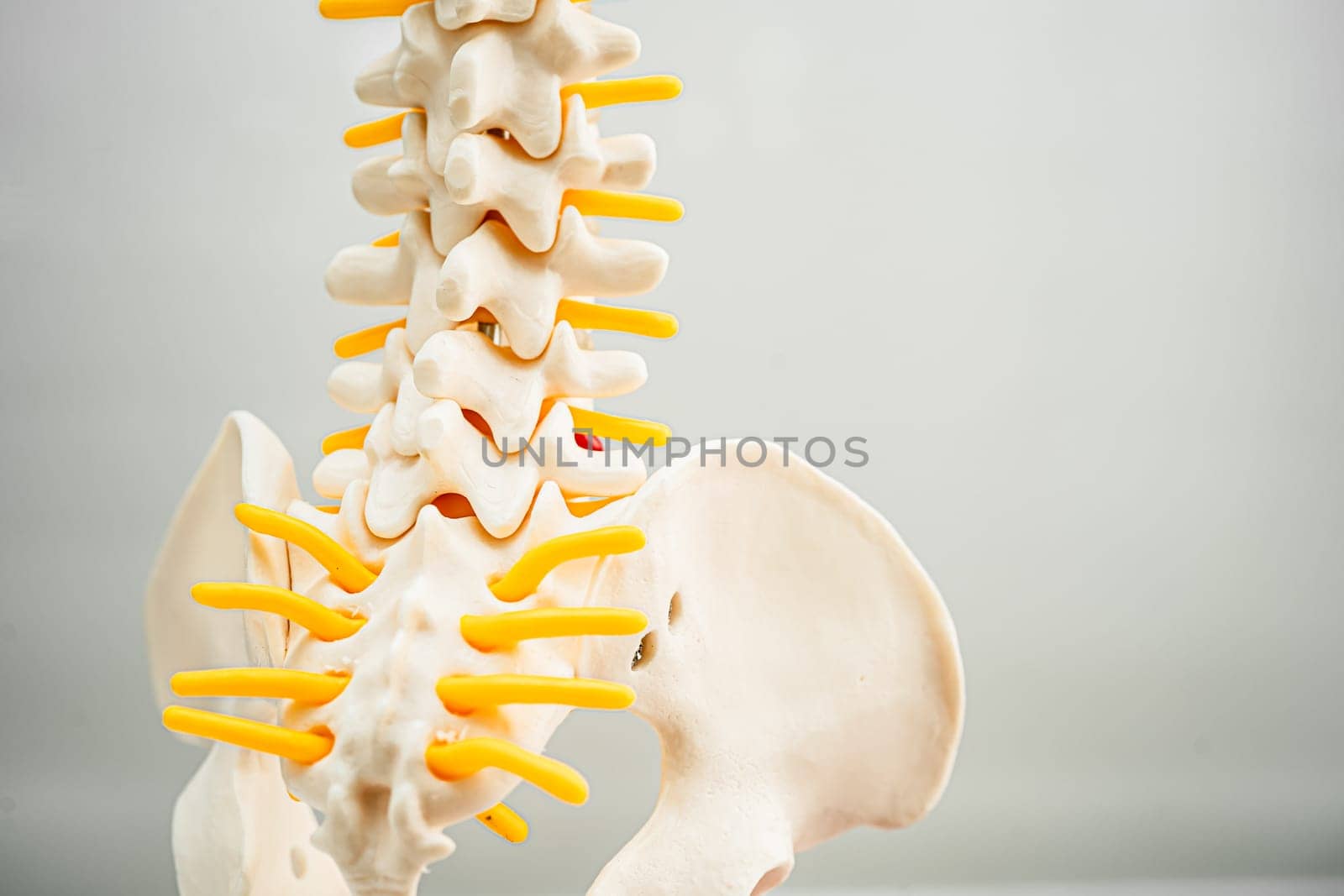 Lumbar spine displaced herniated disc fragment, spinal nerve and bone. Model for treatment medical in the orthopedic department.