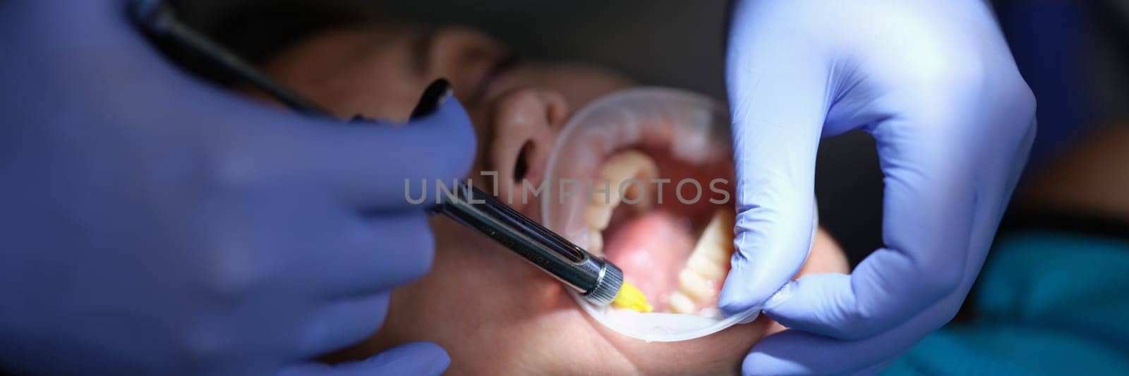 Dentist doctor applying adhesive for veneers and prosthetics in clinic closeup. Anesthesia in dentistry concept