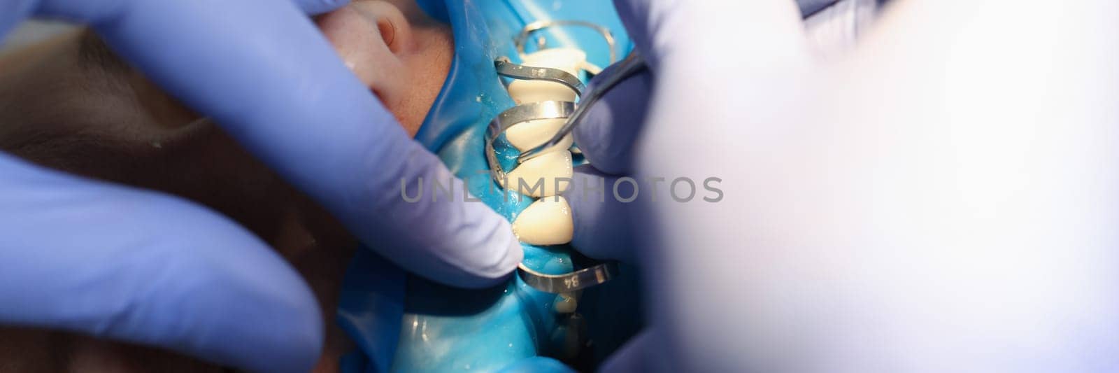 Doctor dentist fixing veneer on patient teeth using metal tools closeup. Prosthetics in dentistry concept