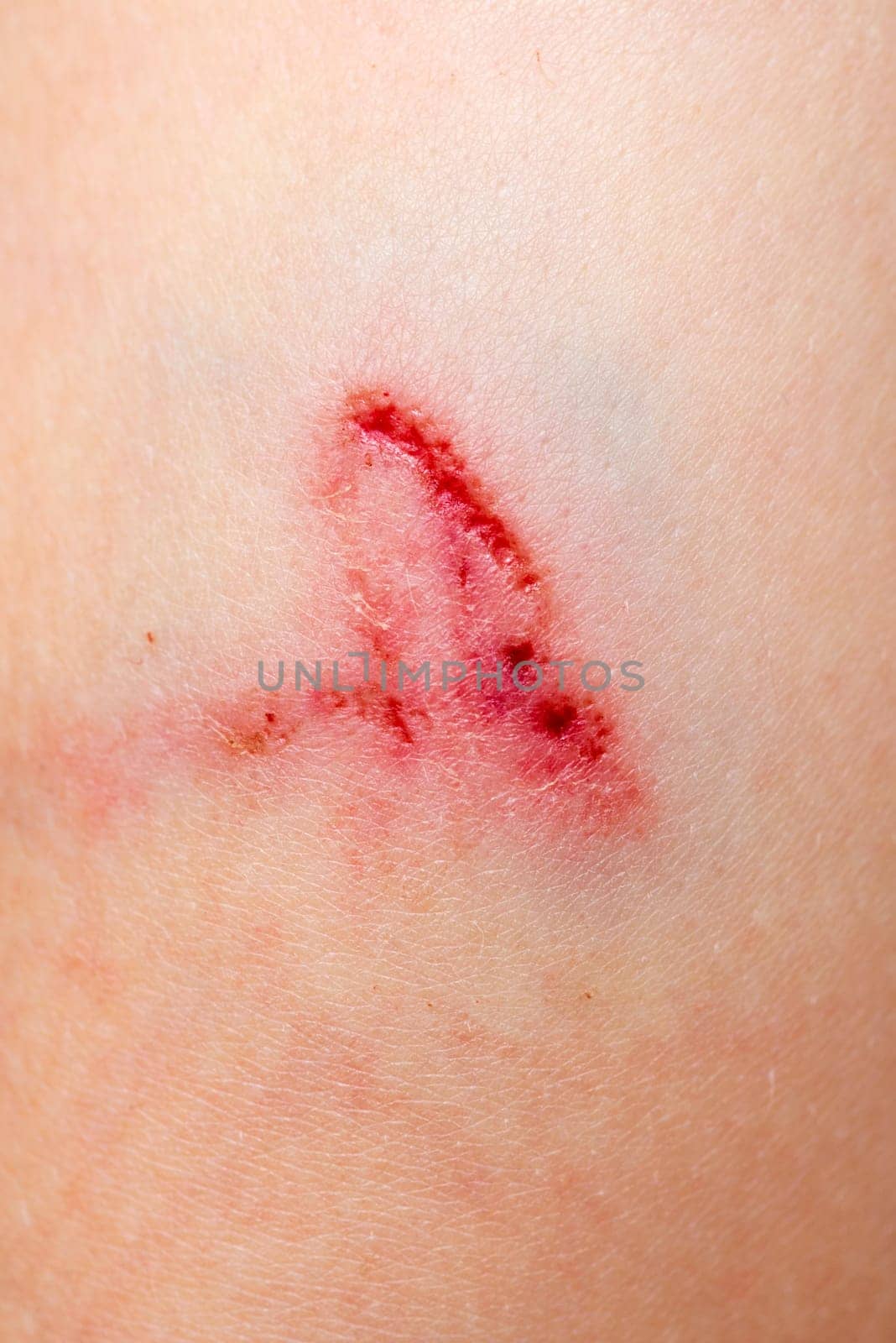 A wound on the human body, deep cut, scar closeup. Deep scratches on the skin with bruises.
