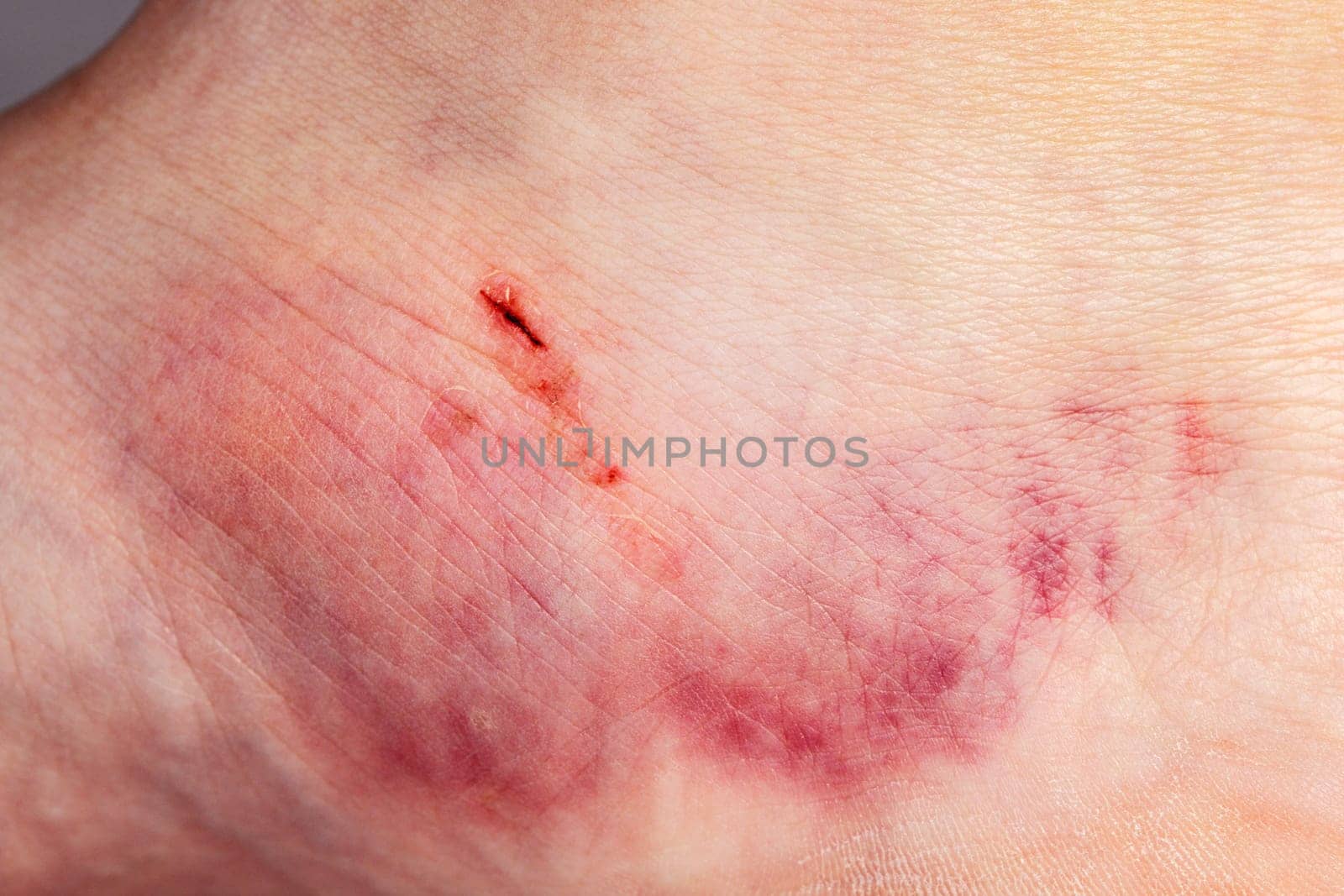 Close-up on the bruise on the skin of the leg of an injured woman. Close up on a bruise on the skin of an injured woman's leg. Gender Violence Concept.