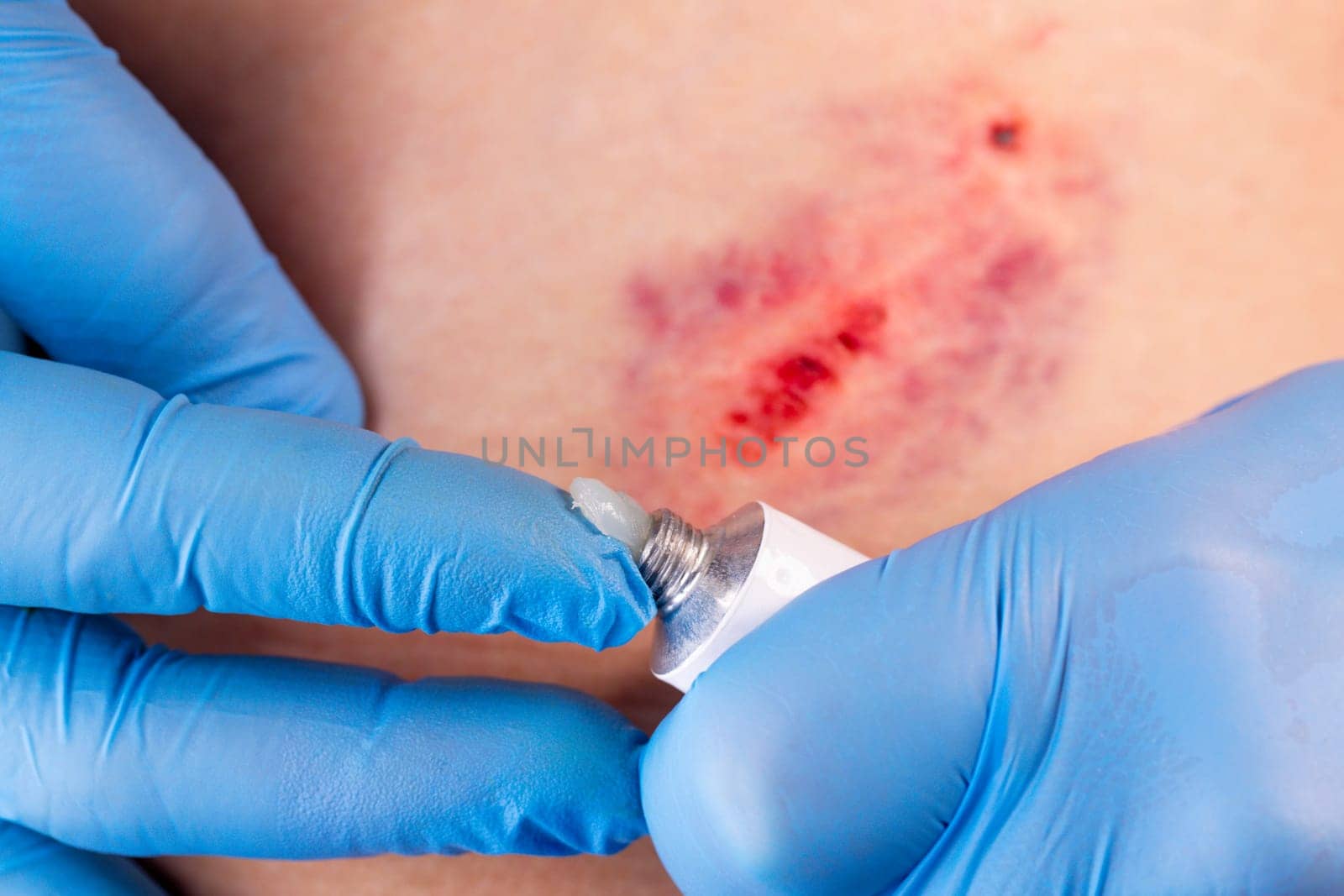 Doctors hands in gloves performs the treatment the wound with the help of ointment. Hematoma of tissue after a bruise or contusion.