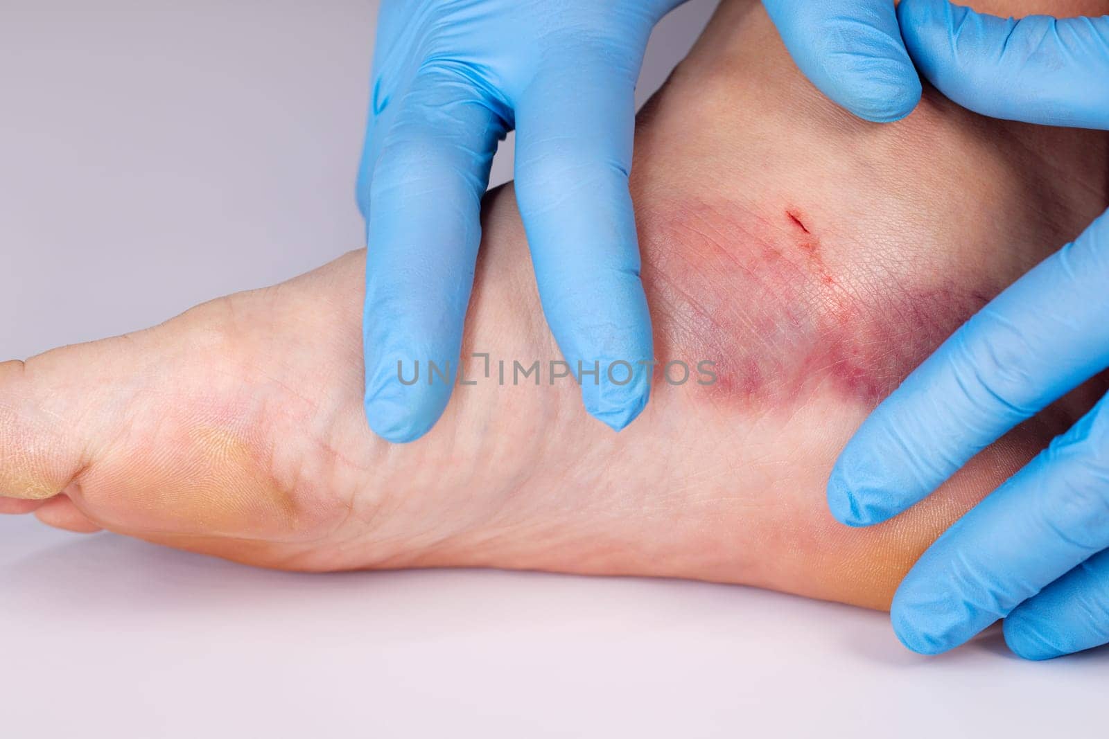 Doctor is examining an injured foot with bruise and scratch. Bruise on womans leg skin.