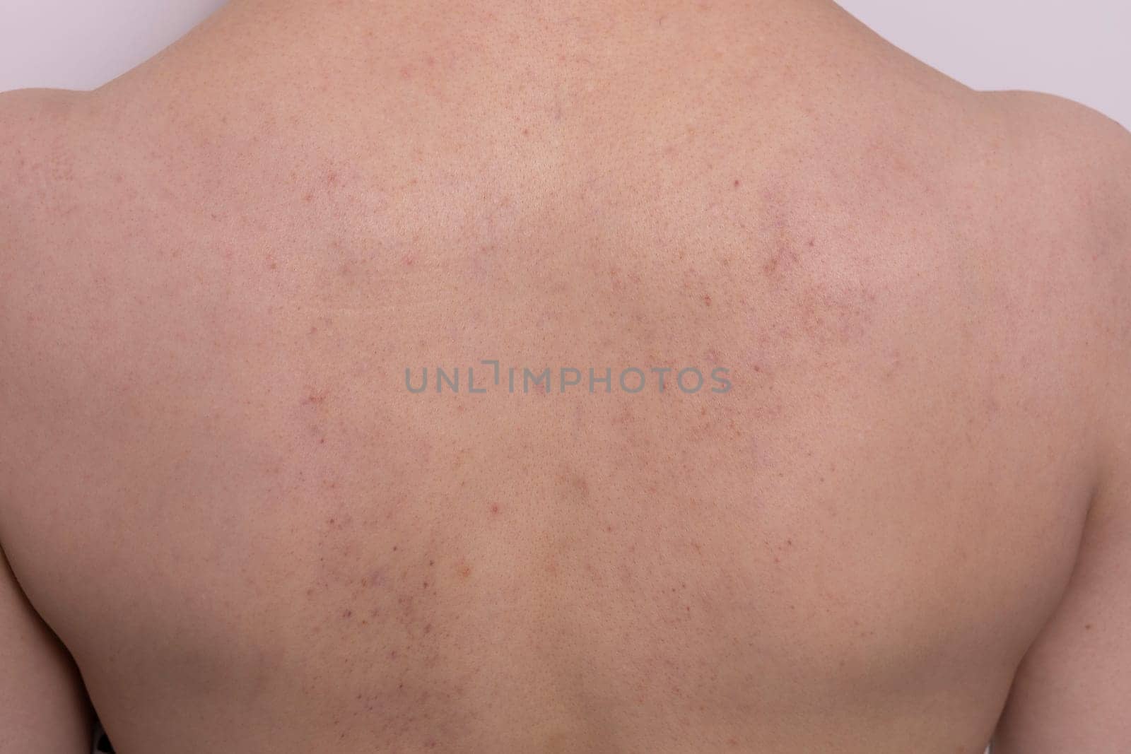 Close up bruises, broken capillaries after cupping, anti cellulite massage procedure on female back. Feeling unwell, Bad Effect, consequences after massage. Complications. Horizontal Plane.