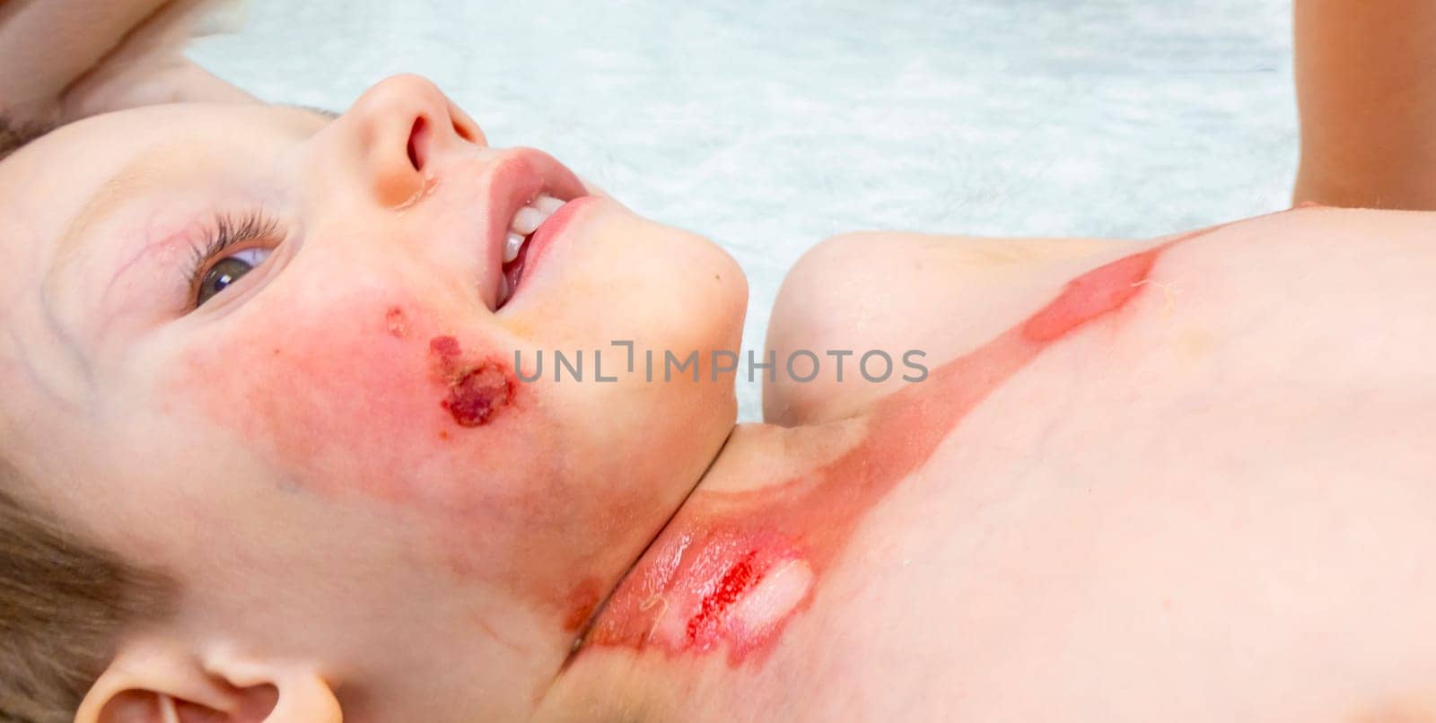 medical procedure dressing a boy with a first-degree burn from boiling water on his face, neck and chest