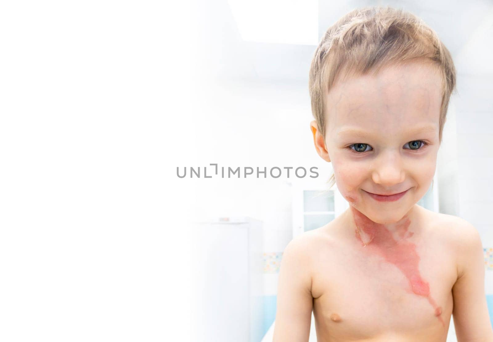 medical procedure dressing a boy with a first-degree burn from boiling water on his face, neck and chest