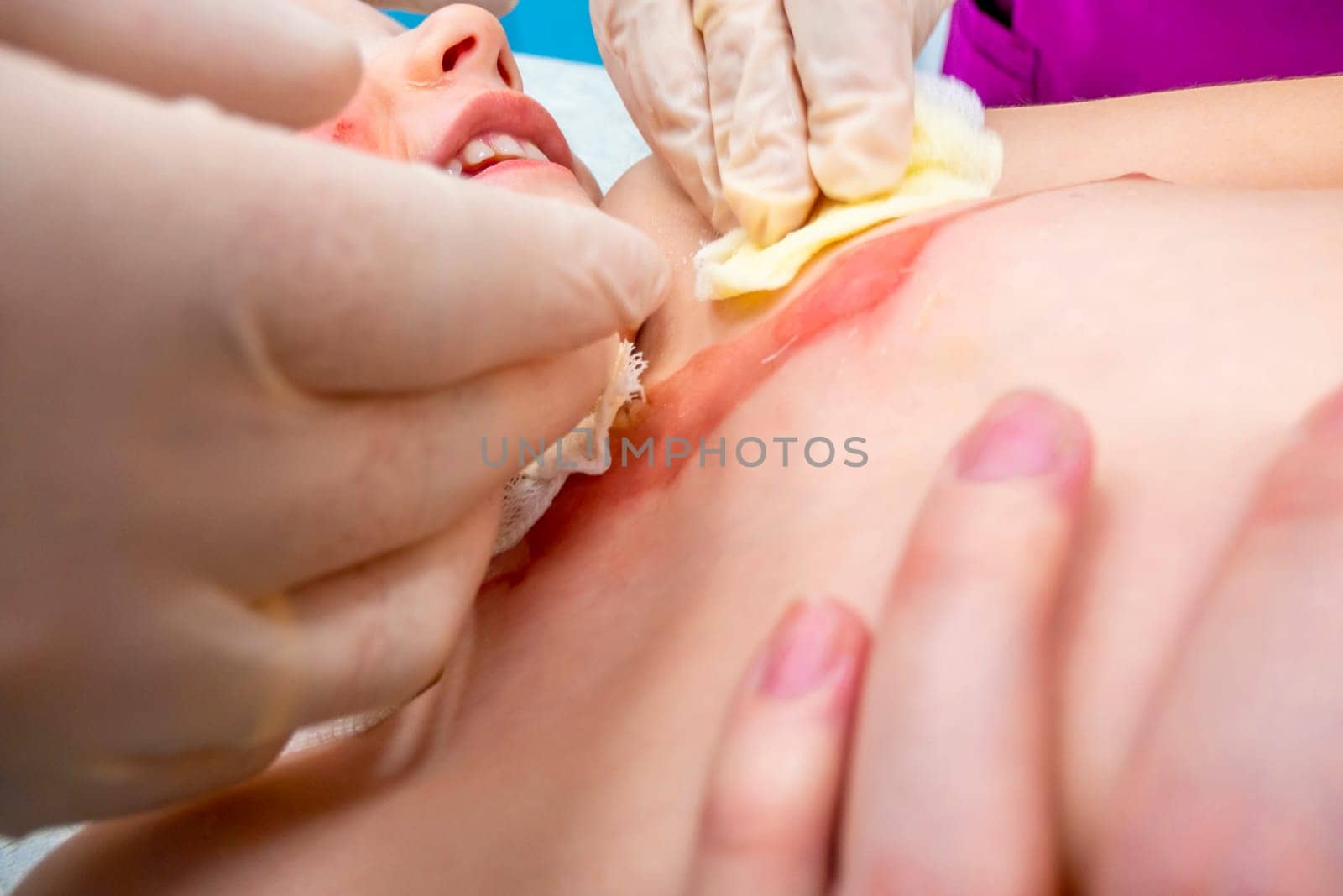 medical procedure dressing a boy with a first-degree burn from boiling water on his face, neck and chest