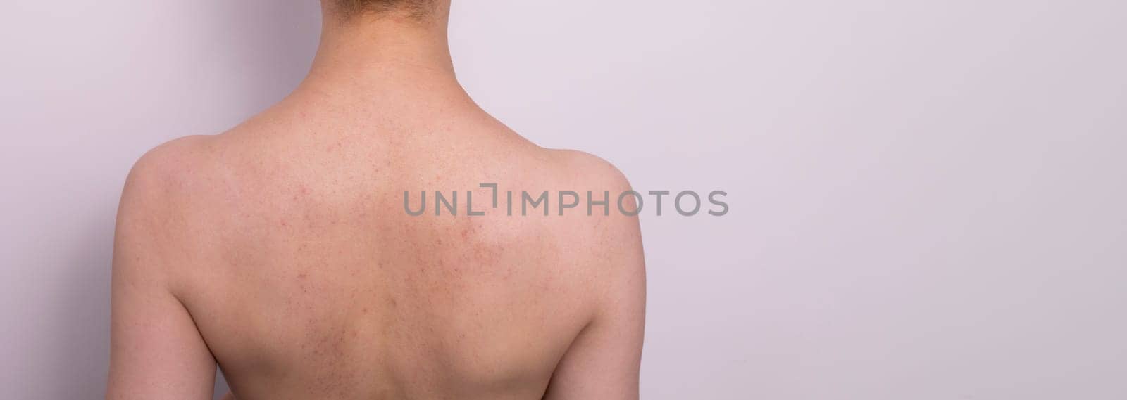Bruises, Broken Capillaries After Cupping, Anti Cellulite Massage Procedure On Woman's Back. Feeling Bad, Effect, Consequences After Massage. Complications. Copy Space For Text Horizontal Plane.