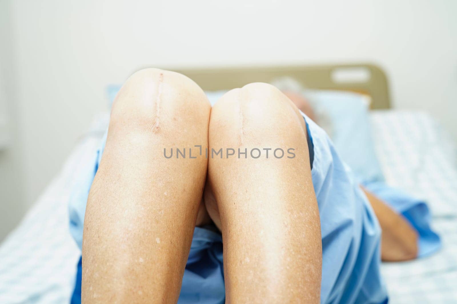 Asian elderly woman patient with scar knee replacement surgery in hospital.