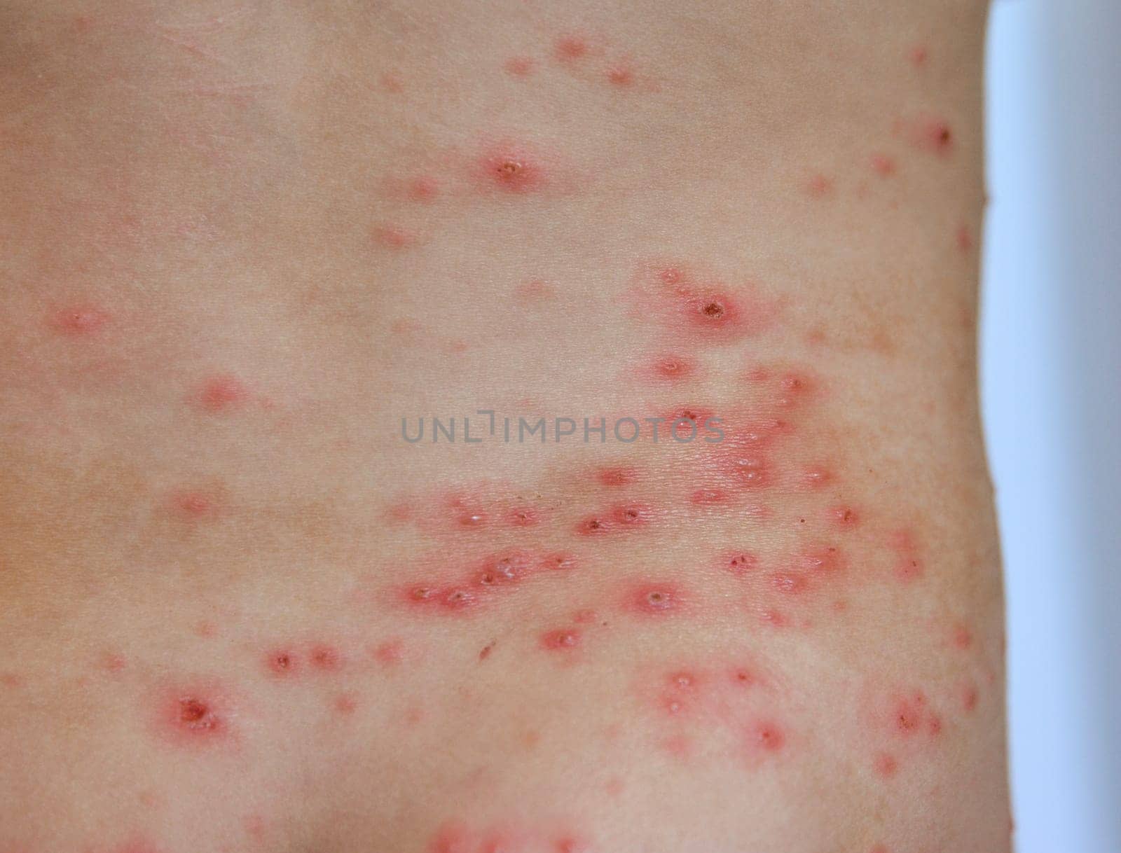 Closeup of Chicken pox rash - Viral infections disease Varicella