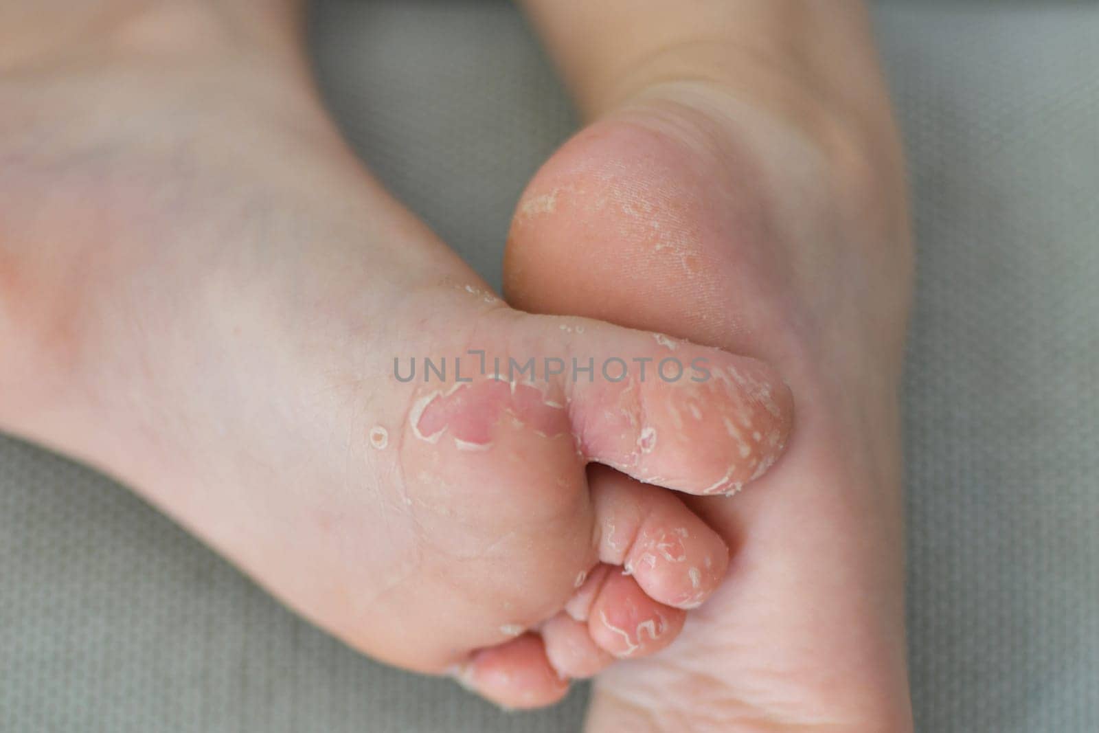 Enterovirus foot hand mouth disease Skin peeled off on the legs of a child Cocksackie virus