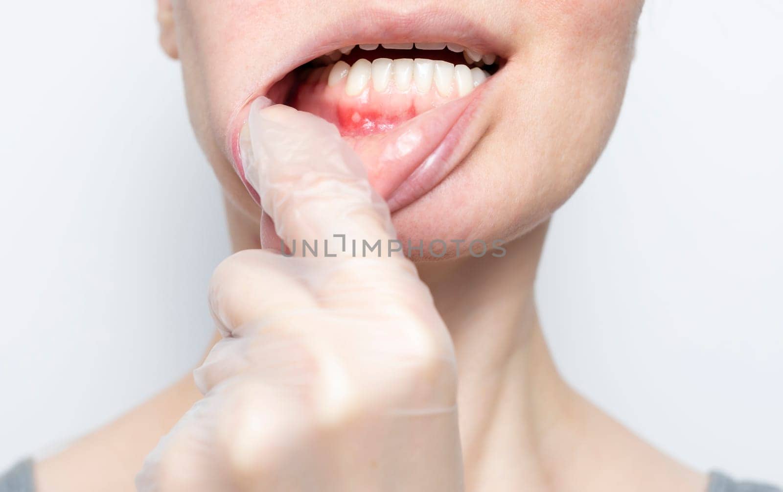 Closeup aphthous stomatitis on gum. Doctor checks small ulcer in woman's mouth. Physician's hand in glove pulls female Caucasian's lip, white background. Diagnosis and treatment concept. Horizontal.