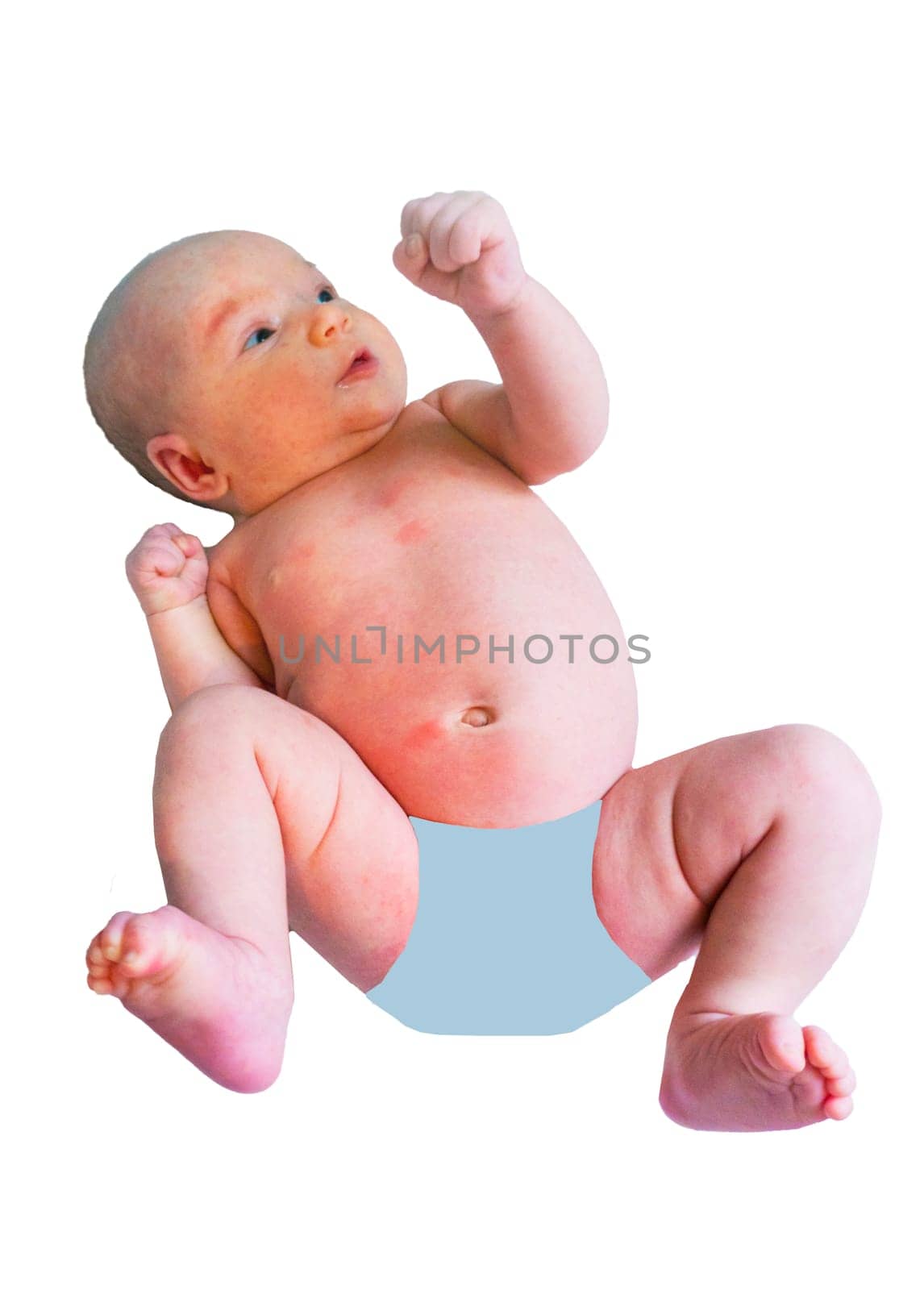 baby allergy skin. child dermatitis symptom problem rash. suffering atopic symptom on skin cheeks. concept child health. allergic reaction miliaria, prickly heat on baby's back.