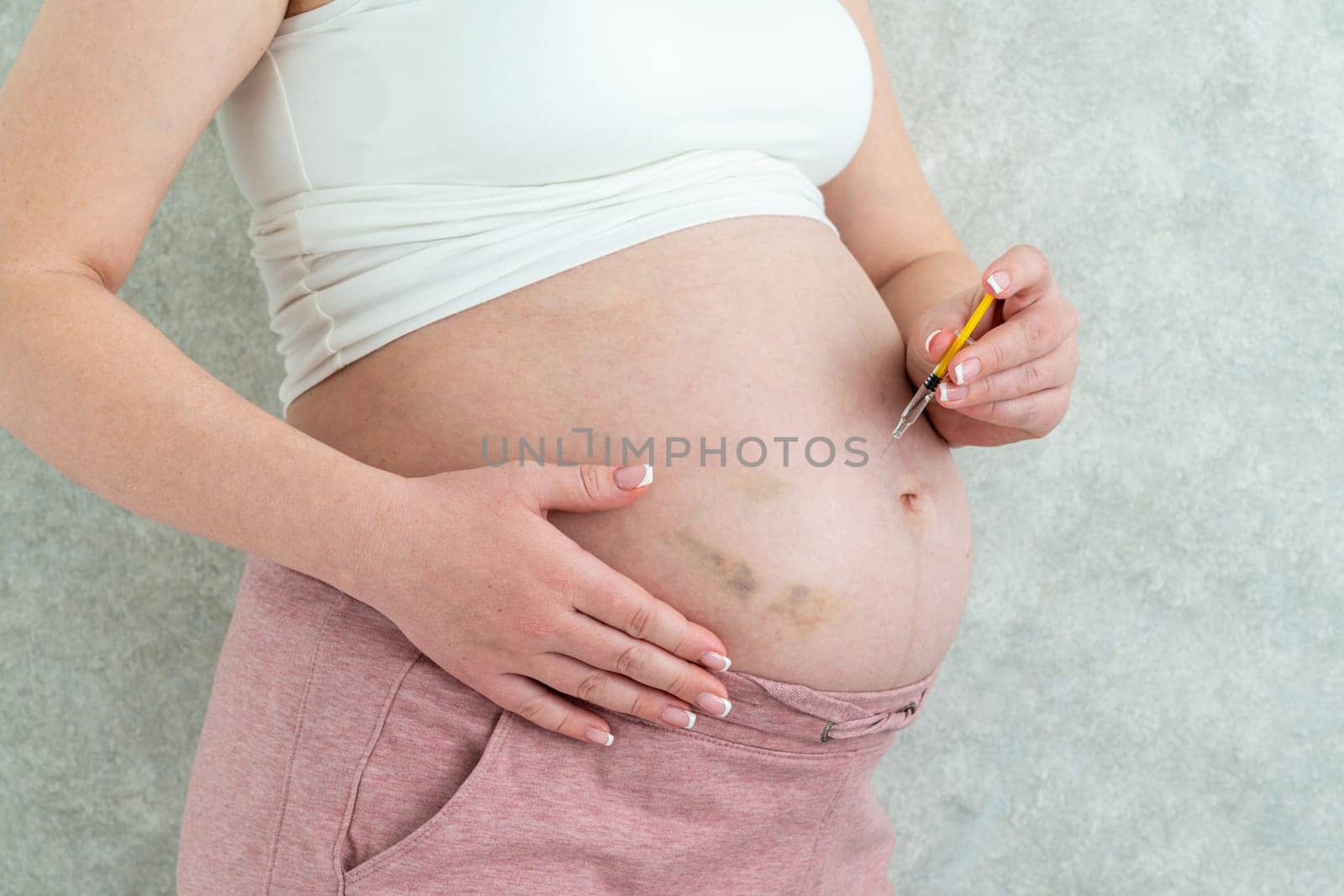 Blood thinners concept. Pregnant woman making injection in stomach with bruises by Mariakray