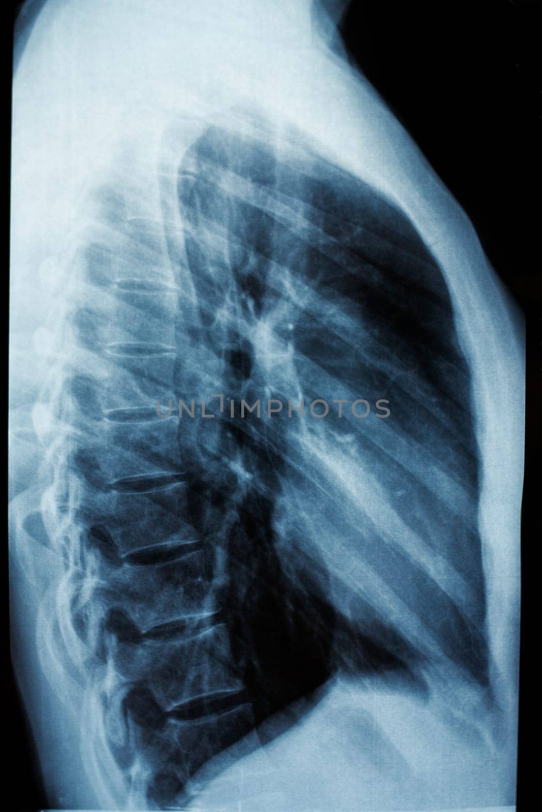 Diagnosis with x-ray. Fluorography of the human chest, side view.