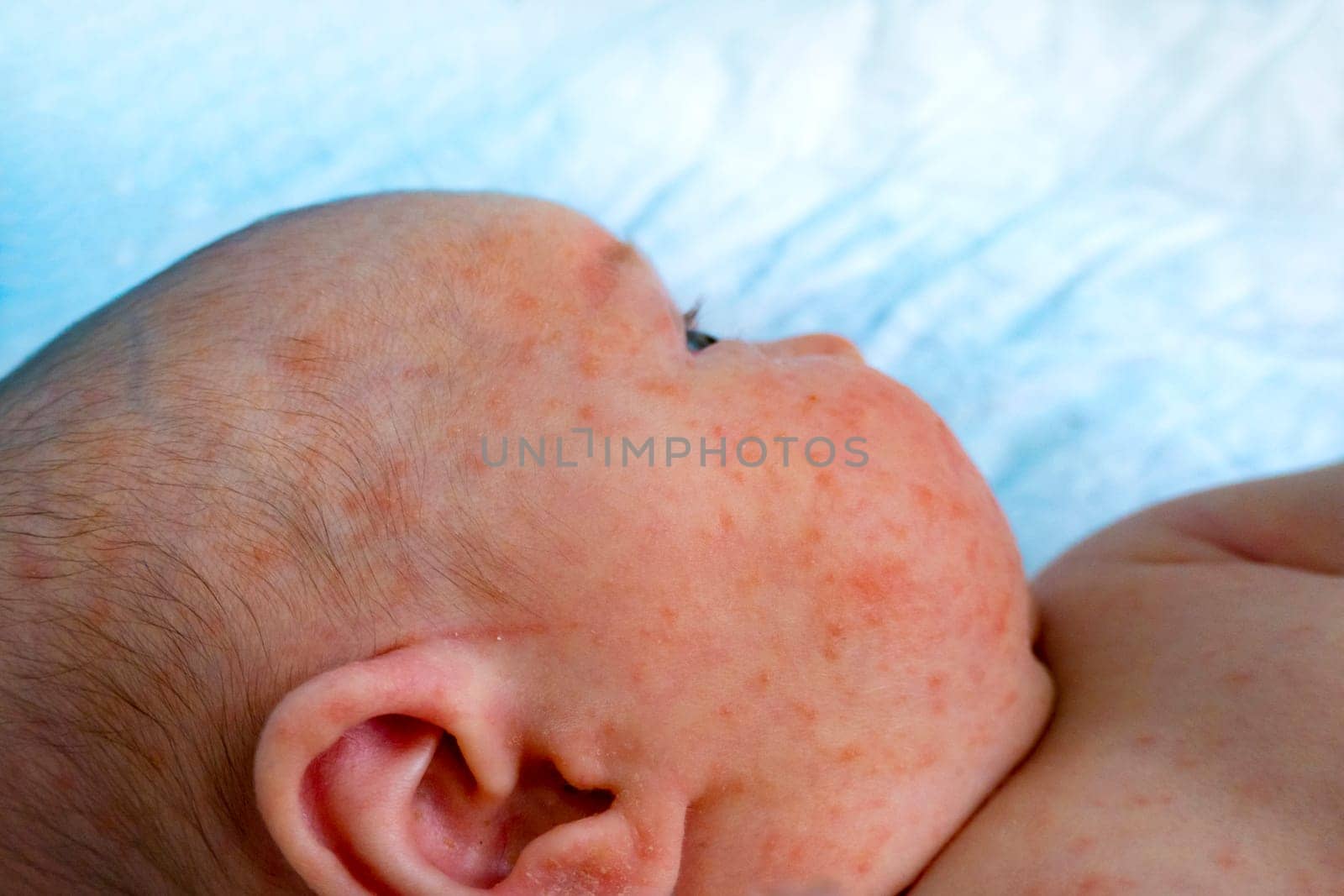 baby allergy skin. child dermatitis symptom problem rash. suffering atopic symptom on skin cheeks. concept child health. allergic reaction miliaria, prickly heat on baby's back.