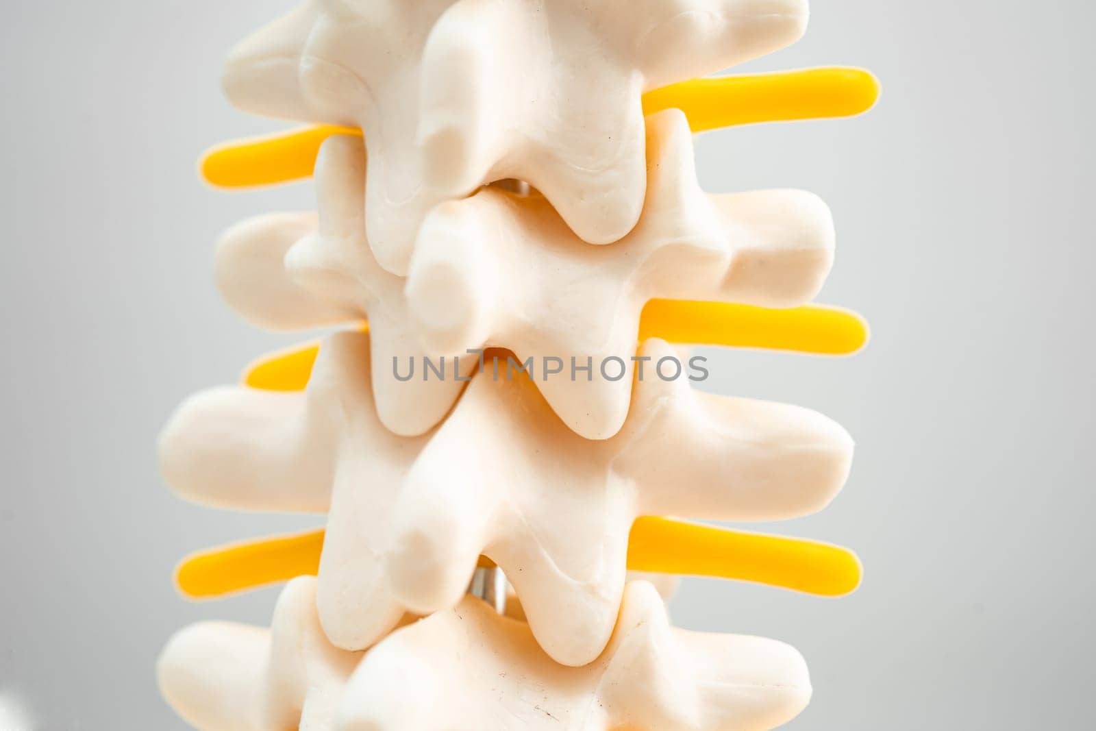 Lumbar spine displaced herniated disc fragment, spinal nerve and bone. Model for treatment medical in the orthopedic department. by pamai