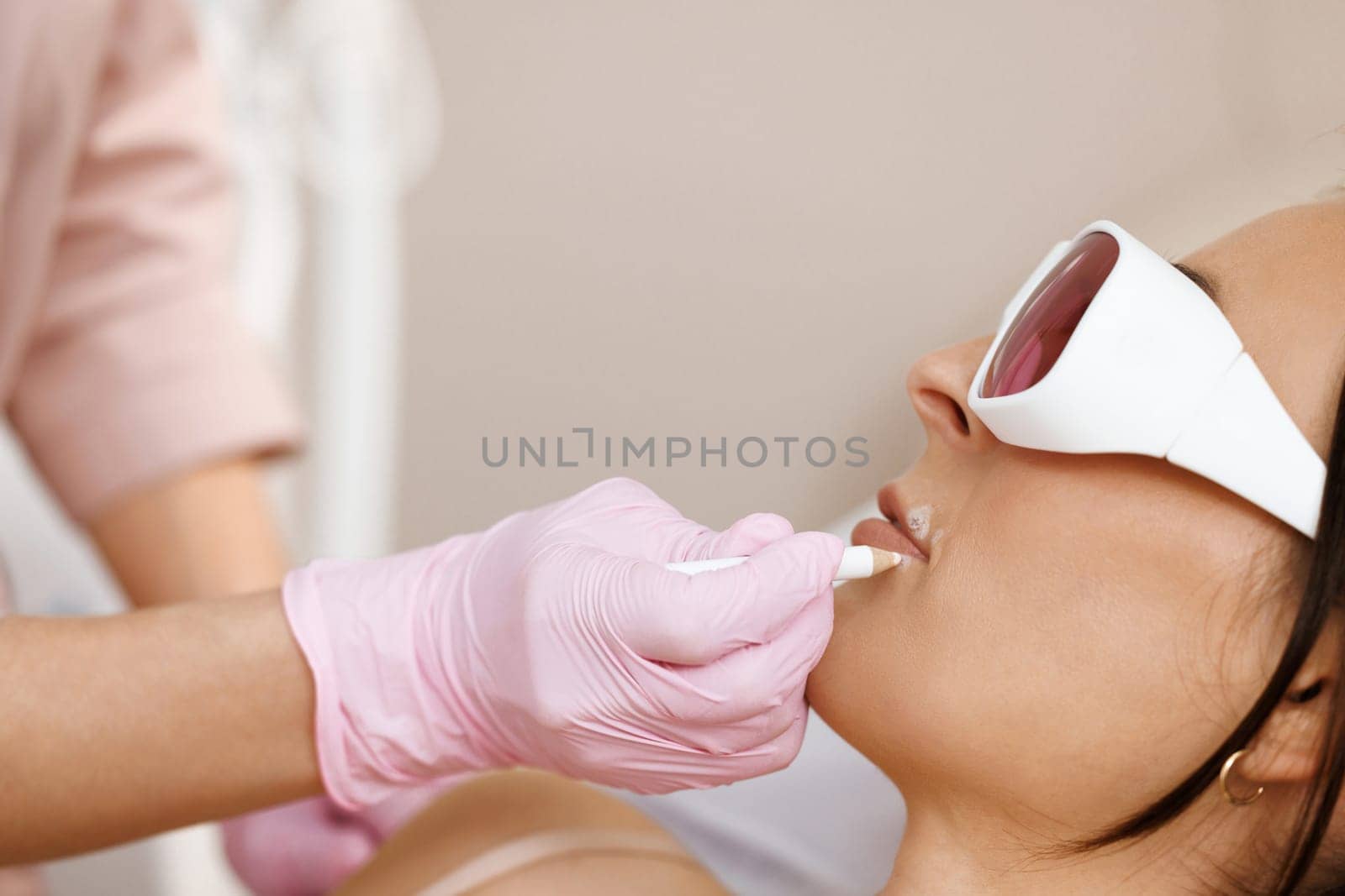 Women's hands in gloves mark the area for epilation and protection of moles with pencil. Laser hair removal. Laser hair removal specialist draws on moles on the woman's face with a protective pencil by uflypro