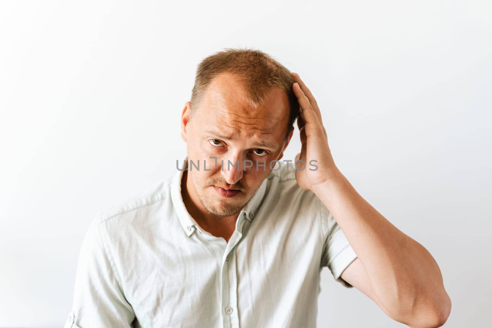Young sad bald man with depression at hair loss problems looking angry and frustrated and holding his head. Before hair transplantation.