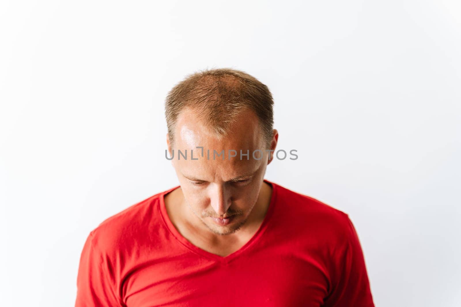 Before hair transplantation. Young bald man with hair loss problems. White background with copy space