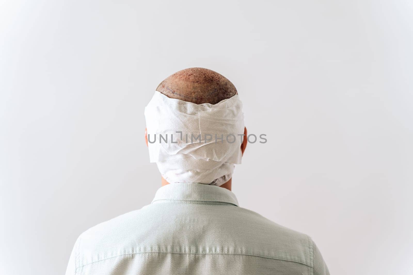 After hair transplantation surgical technique that moves hair follicles. Young bald man in bandage with hair loss problems. White background with copy space by Ostanina
