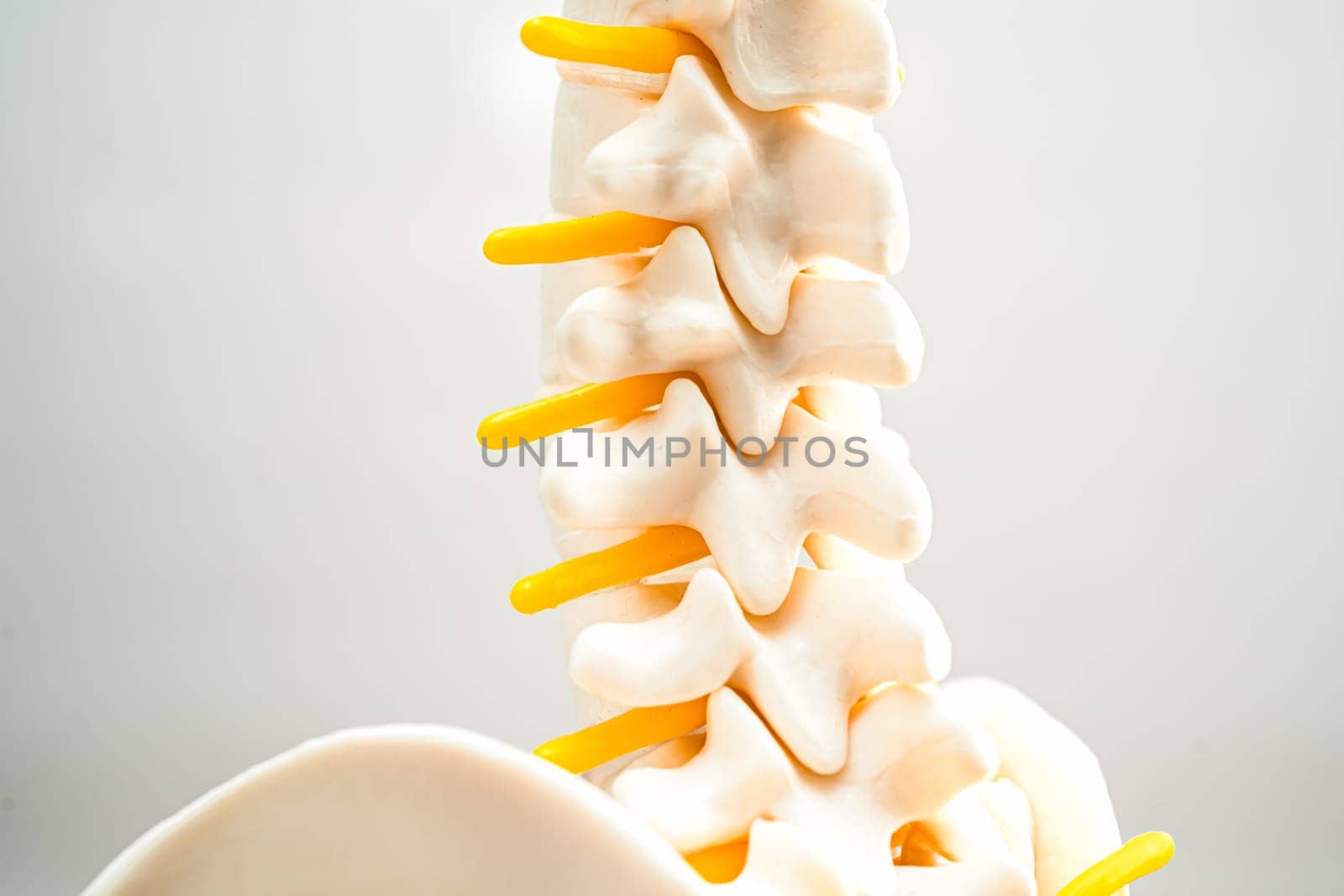 Lumbar spine displaced herniated disc fragment, spinal nerve and bone. Model for treatment medical in the orthopedic department.