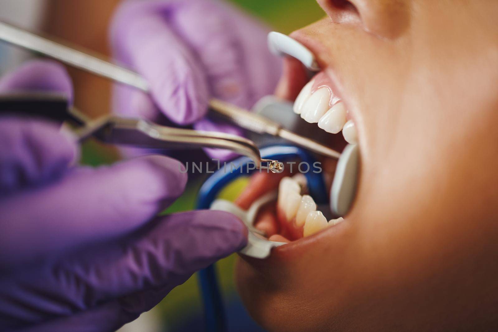 Cropped shot of a beautiful young woman is at the dentist. She sits in the dentist's chair and the dentist sets braces on her teeth putting aesthetic self-aligning lingual locks.