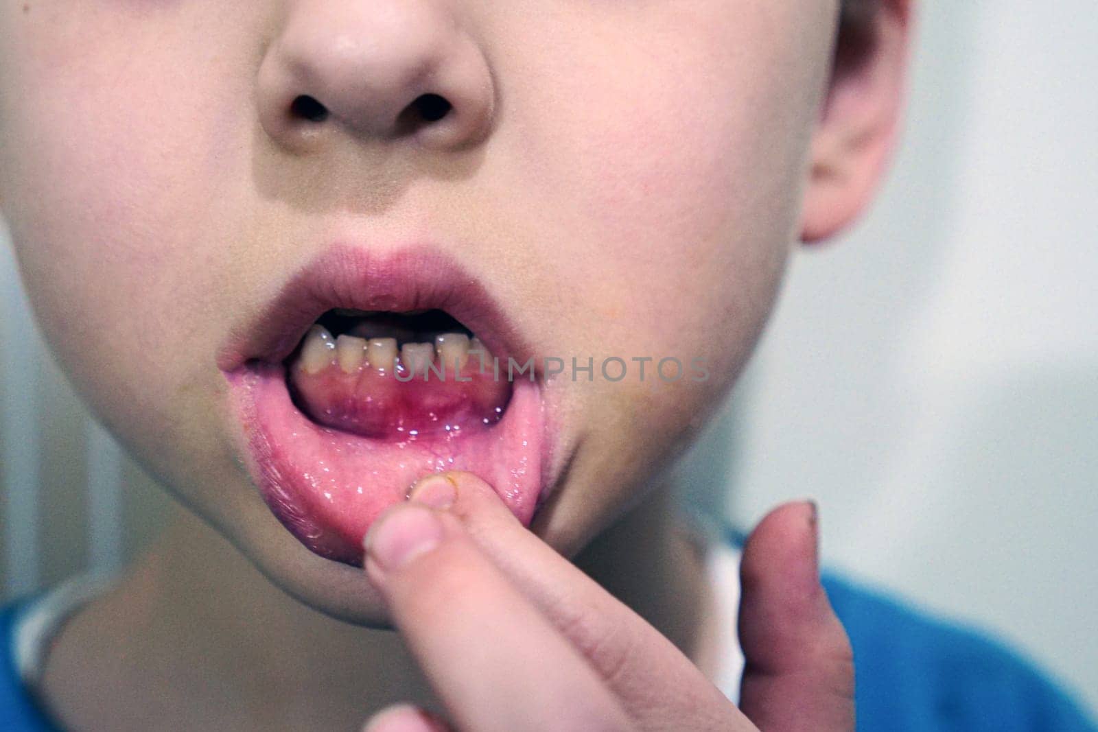 7-year-old child's primary tooth loss, a child with a missing anterior tooth, close-up, by nhatipoglu