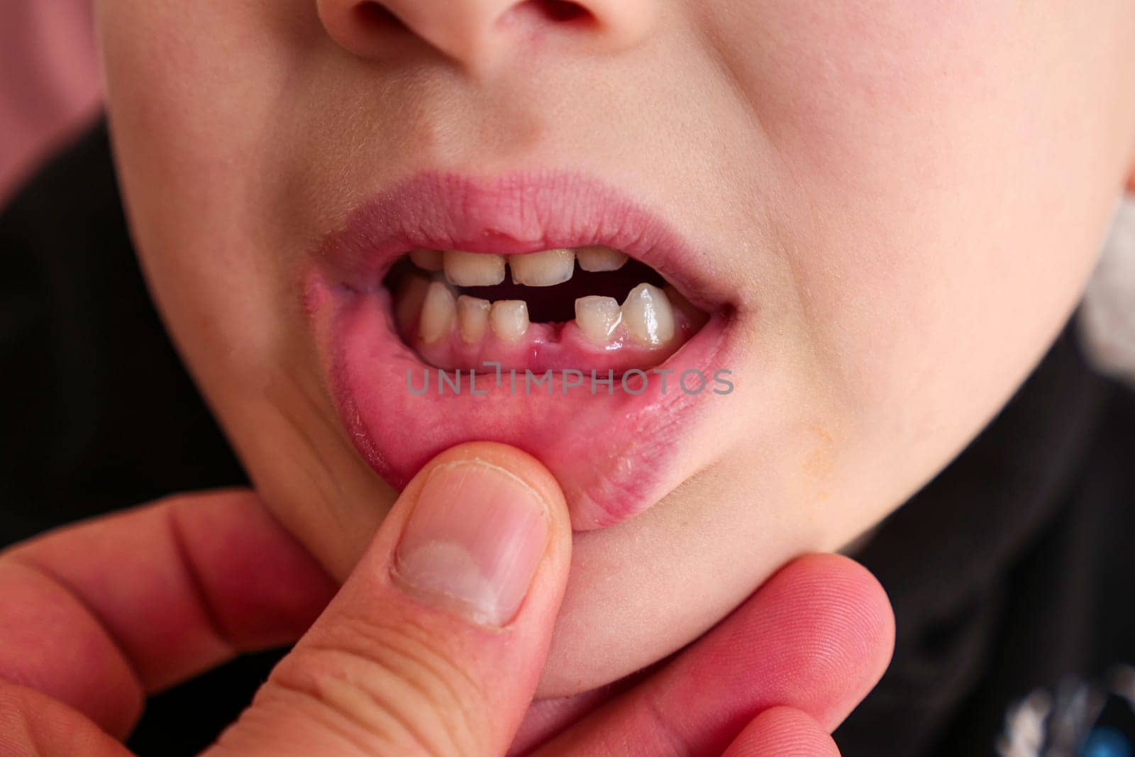 7-year-old child's primary tooth loss, a child with a missing anterior tooth, close-up,