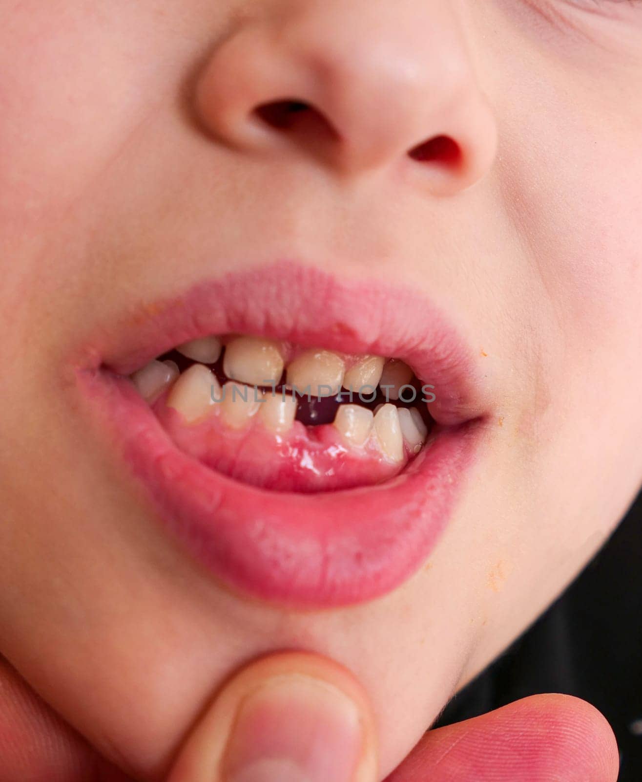 7-year-old child's primary tooth loss, a child with a missing anterior tooth, close-up,