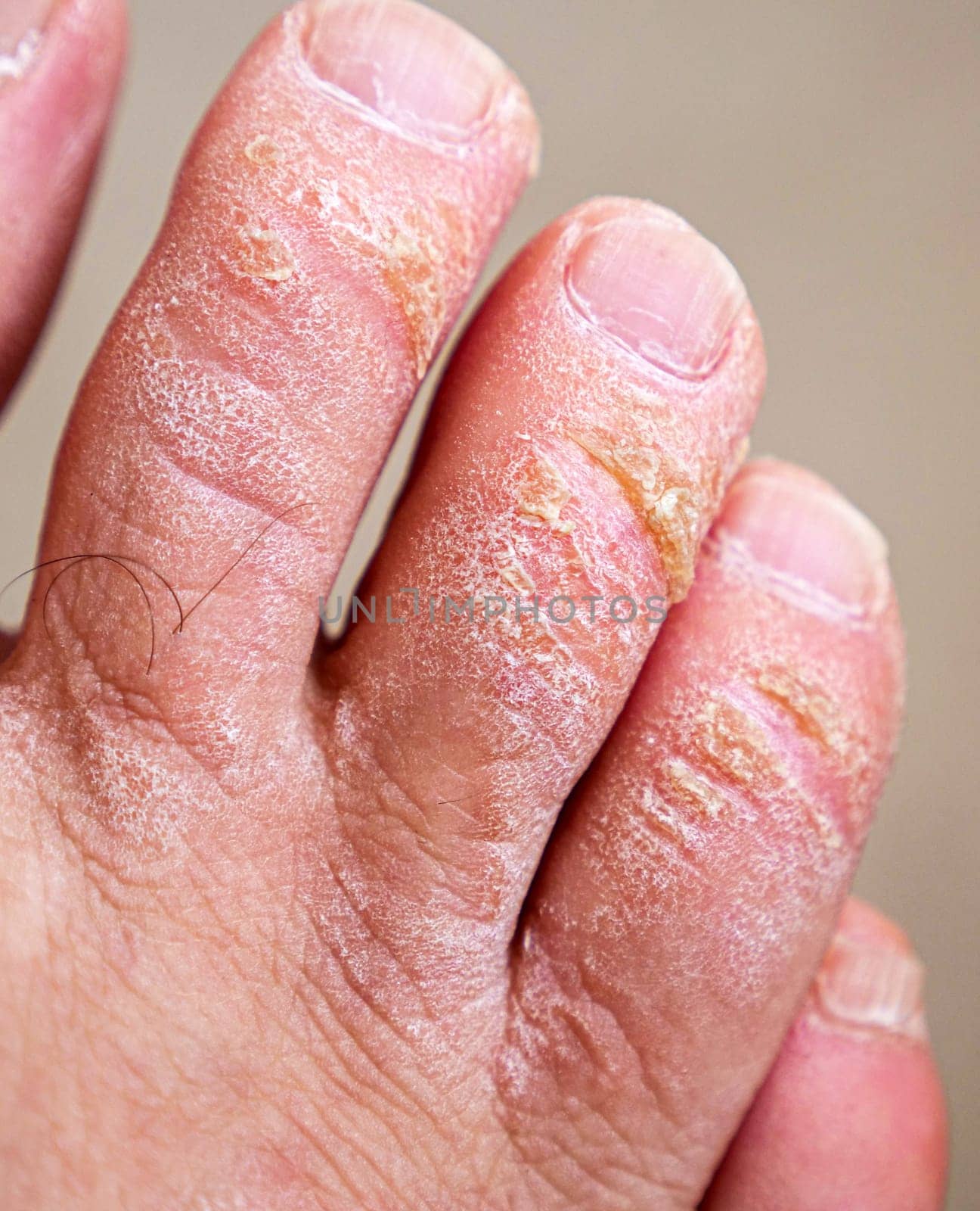 neglected toes, fungus and calluses on the fingers, close-up calloused toes,